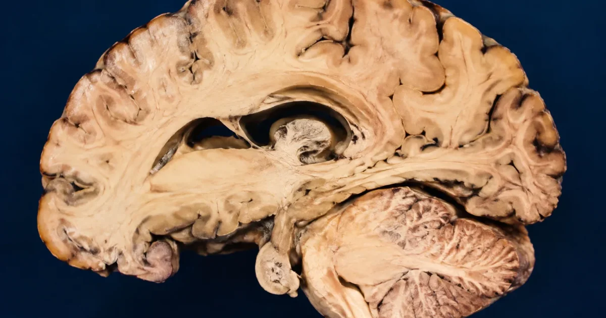 cerveau en coupe montrant zones diminuees