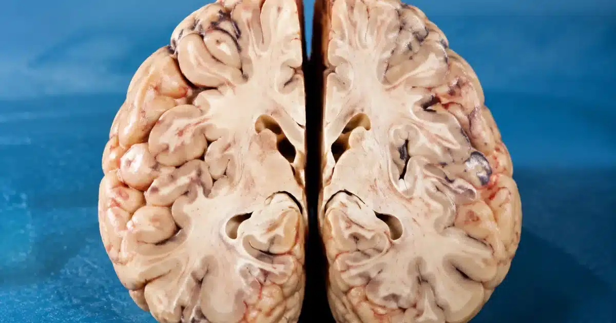 Cerveau humain en coupe montrant deux hemispheres distincts separés par une fissure centrale profonde
